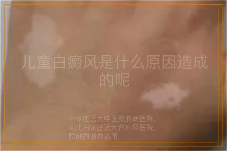 儿童白癜风是什么原因造成的呢