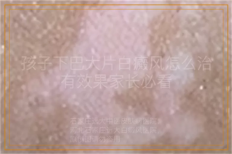 孩子下巴大片白癜风怎么治有效果家长必看
