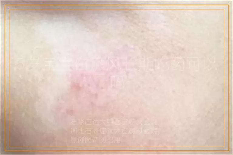 5岁宝宝白癜风长期吃药可以吗