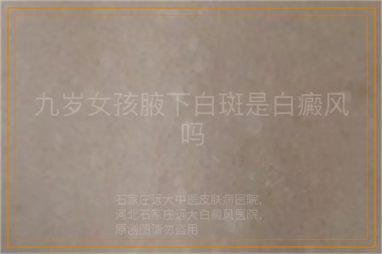 九岁女孩腋下白斑是白癜风吗