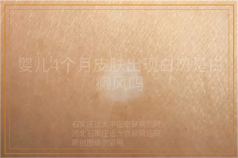 婴儿4个月皮肤出现白斑是白癜风吗