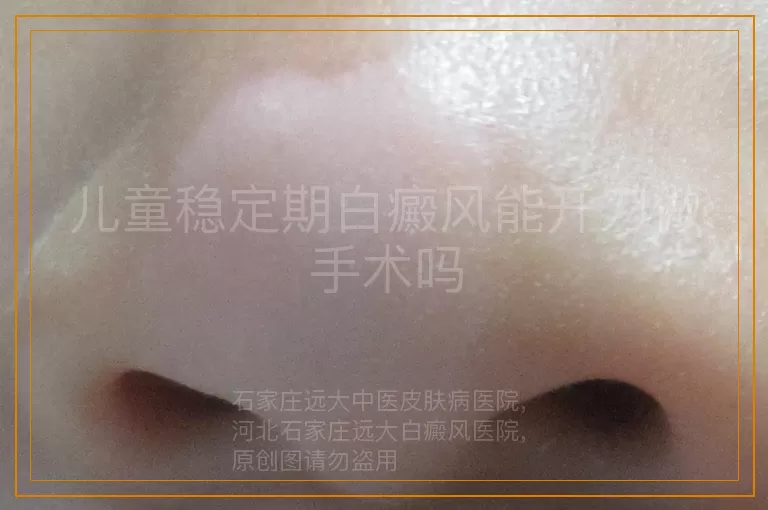 儿童稳定期白癜风能开刀做手术吗