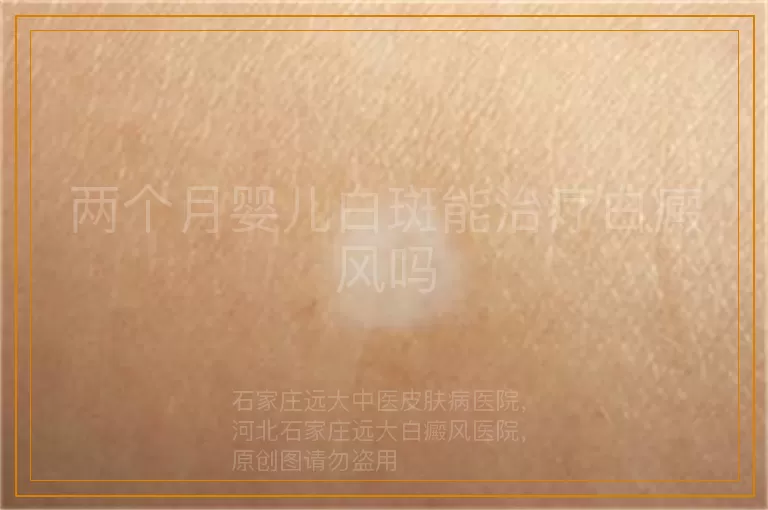 两个月婴儿白斑能治疗白癜风吗