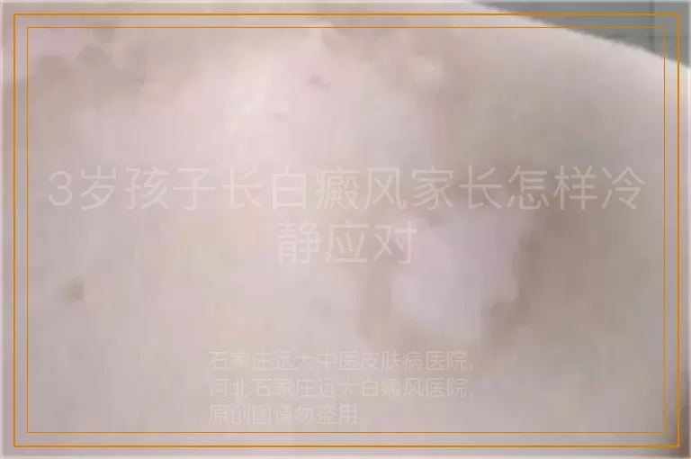 3岁孩子长白癜风家长怎样冷静应对