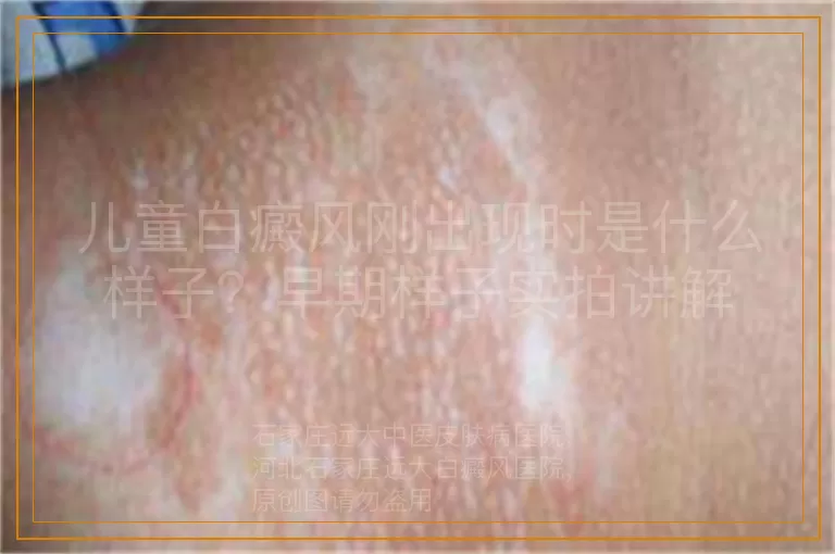 儿童白癜风刚出现时是什么样子？早期样子实拍讲解