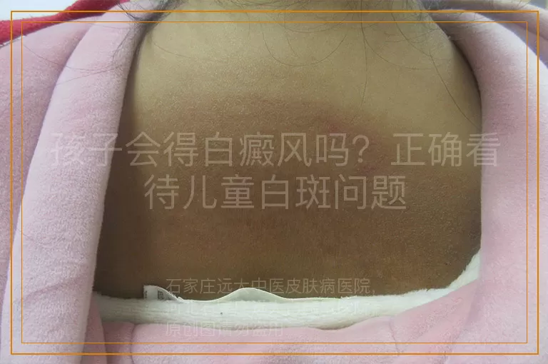 孩子会得白癜风吗？正确看待儿童白斑问题