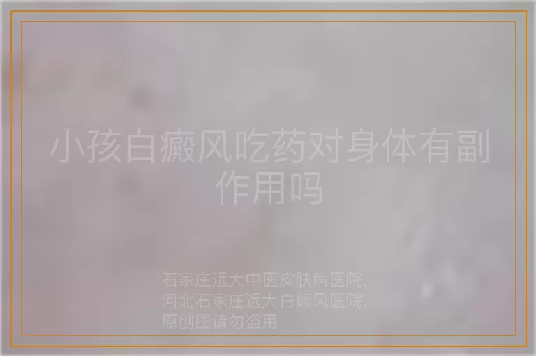 小孩白癜风吃药对身体有副作用吗