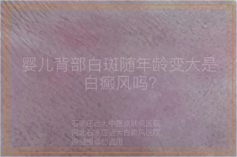 婴儿背部白斑随年龄变大是白癜风吗？