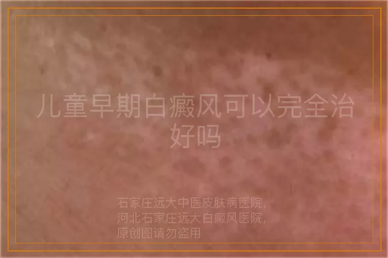 儿童早期白癜风可以完全治好吗