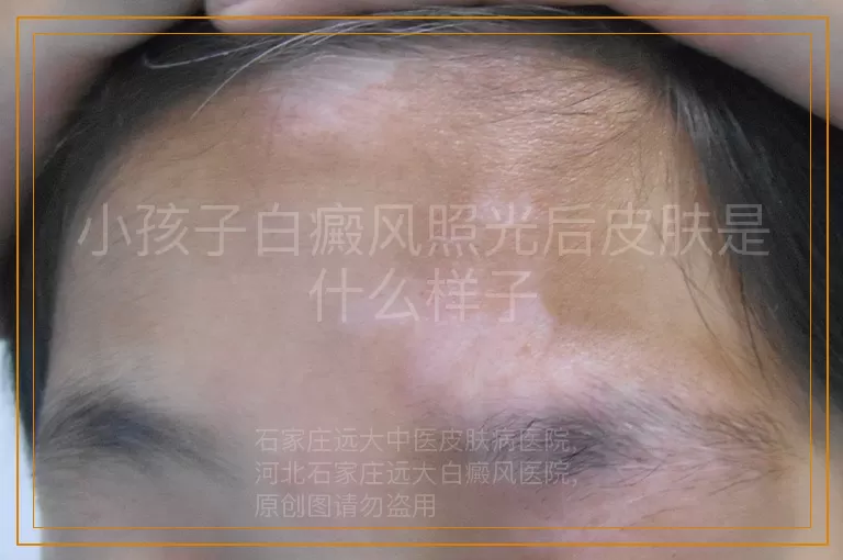 小孩子白癜风照光后皮肤是什么样子