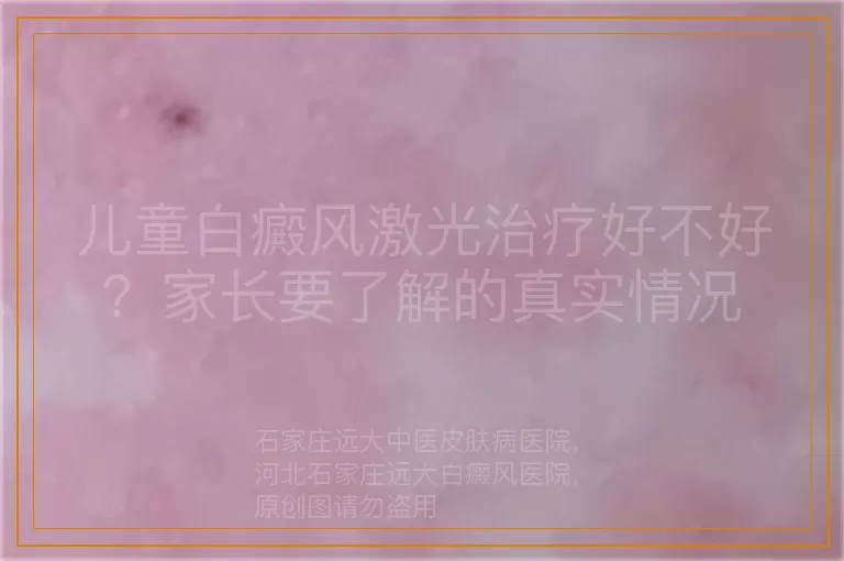 儿童白癜风激光治疗好不好？家长要了解的真实情况