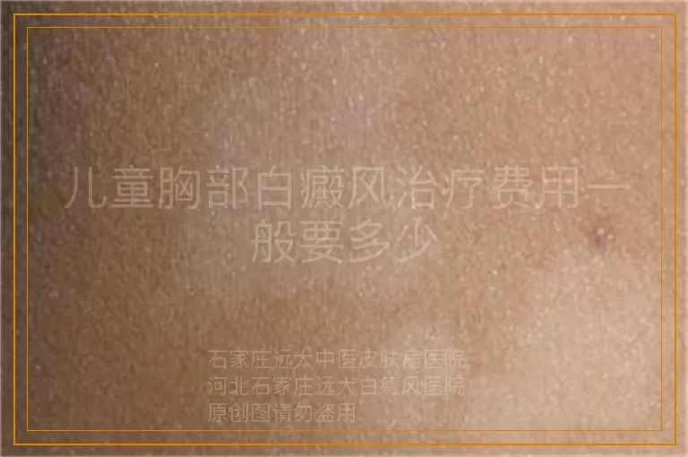儿童胸部白癜风治疗费用一般要多少