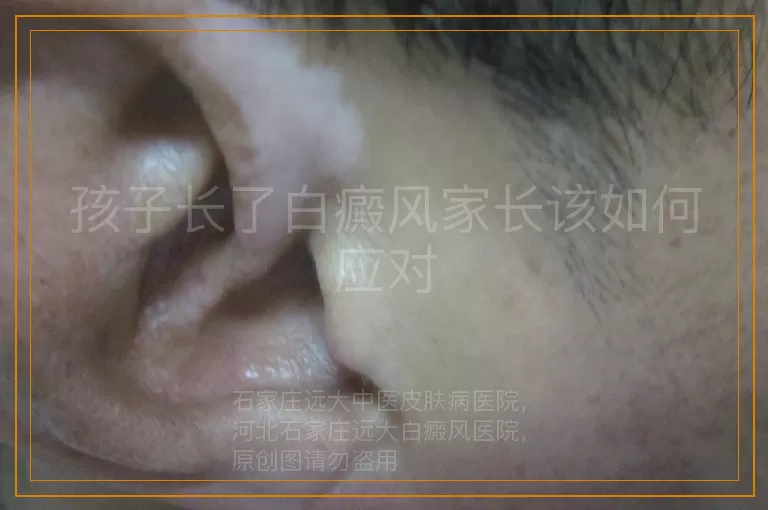 孩子长了白癜风家长该如何应对
