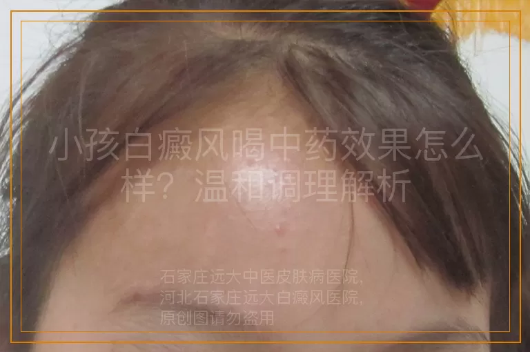 小孩白癜风喝中药效果怎么样？温和调理解析