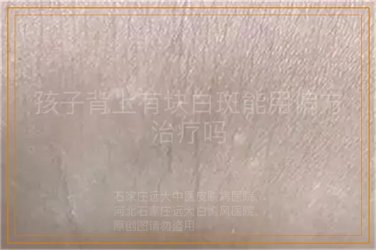 孩子背上有块白斑能用偏方治疗吗