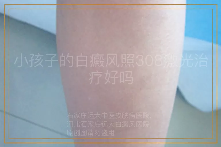 小孩子的白癜风照308激光治疗好吗