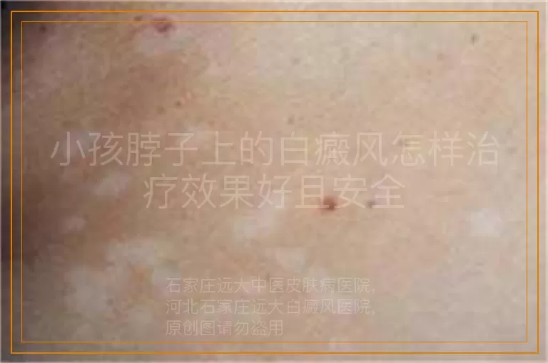 小孩脖子上的白癜风怎样治疗效果好且安全