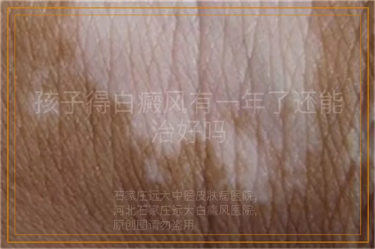 孩子得白癜风有一年了还能治好吗