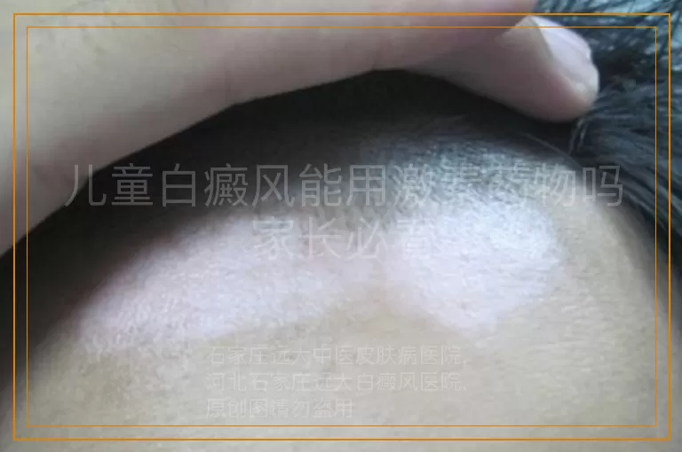 儿童白癜风能用激素药物吗家长必看