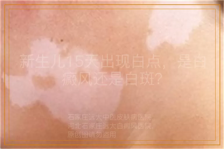 新生儿15天出现白点，是白癜风还是白斑？