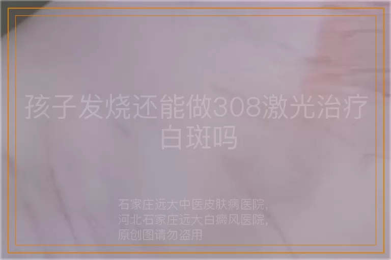 孩子发烧还能做308激光治疗白斑吗
