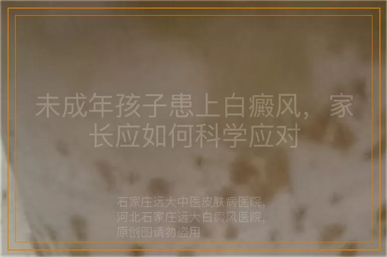 未成年孩子患上白癜风，家长应如何科学应对