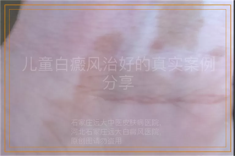 儿童白癜风治好的真实案例分享