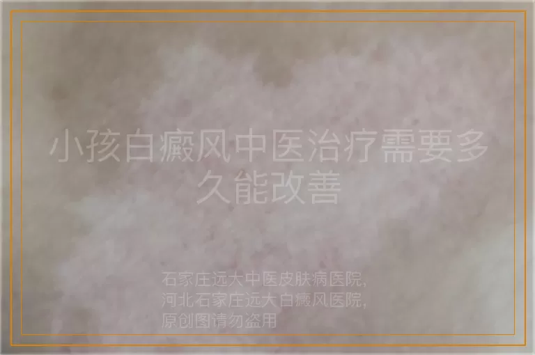 小孩白癜风中医治疗需要多久能改善