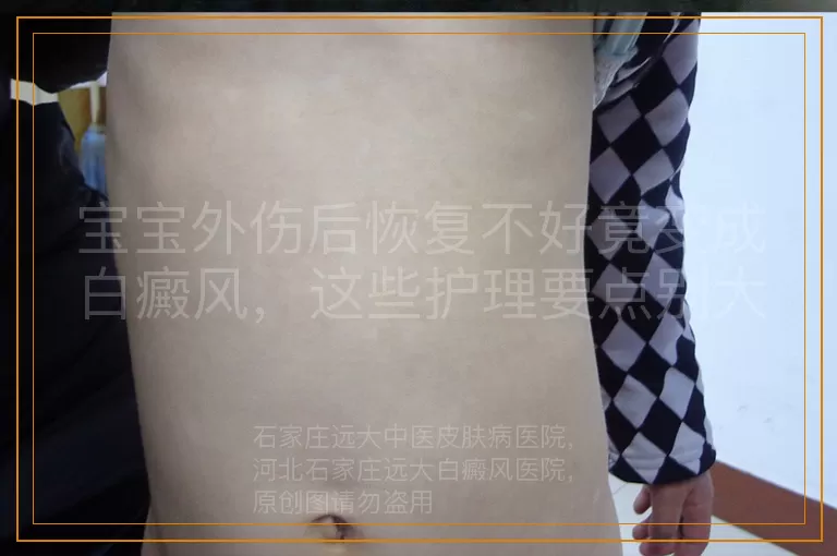 宝宝外伤后恢复不好竟变成白癜风，这些护理要点别大意