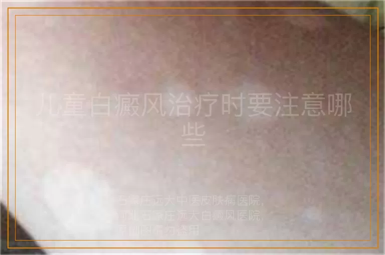 儿童白癜风治疗时要注意哪些