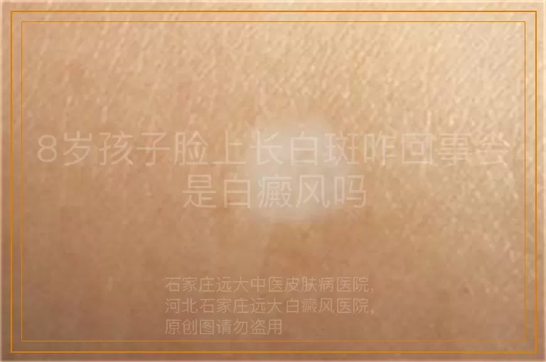 8岁孩子脸上长白斑咋回事会是白癜风吗