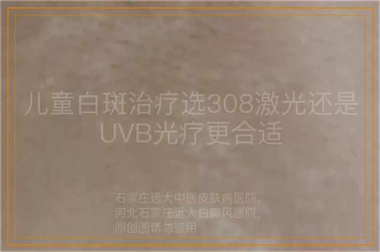 儿童白斑治疗选308激光还是UVB光疗更合适