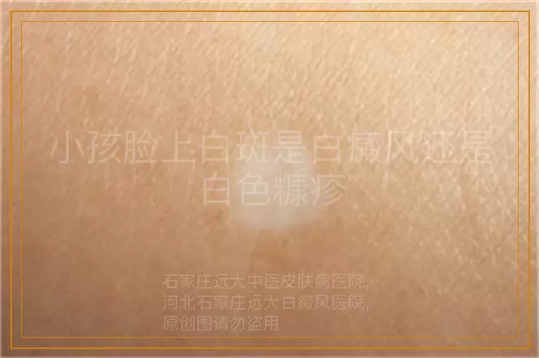 小孩脸上白斑是白癜风还是白色糠疹