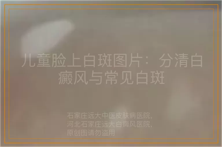 儿童脸上白斑图片：分清白癜风与常见白斑