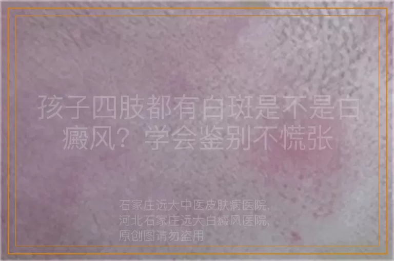 孩子四肢都有白斑是不是白癜风？学会鉴别不慌张