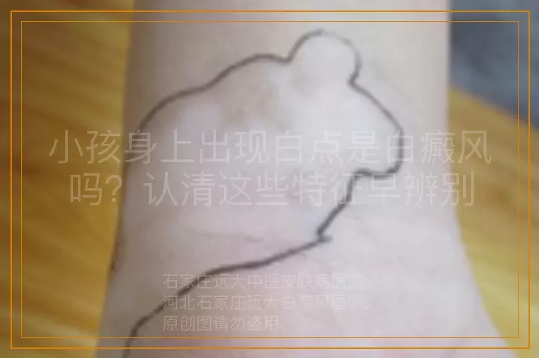 小孩身上出现白点是白癜风吗？认清这些特征早辨别