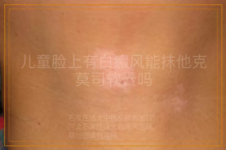 儿童脸上有白癜风能抹他克莫司软膏吗