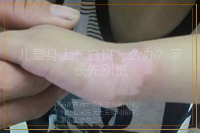 儿童身上长白斑怎么办？家长先别慌