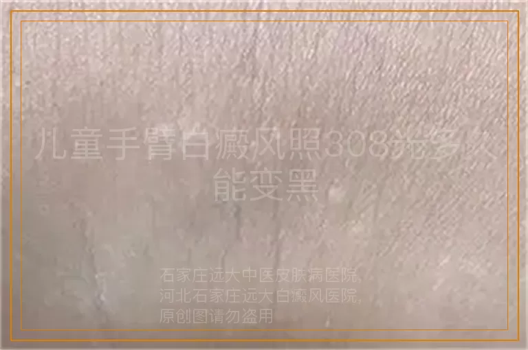儿童手臂白癜风照308光多久能变黑