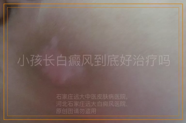 小孩长白癜风到底好治疗吗