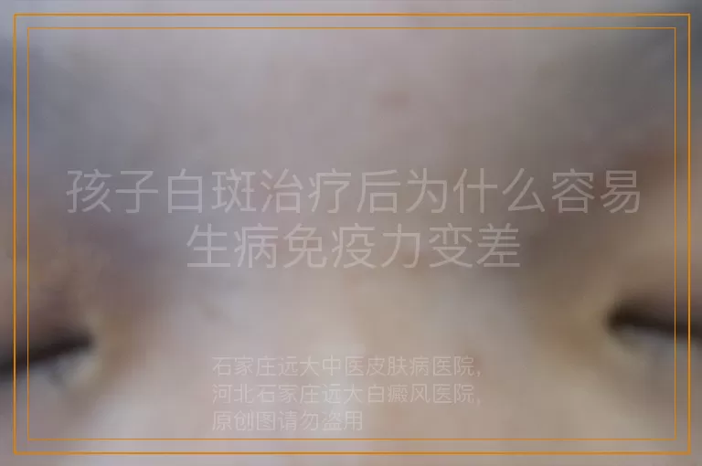 孩子白斑治疗后为什么容易生病免疫力变差
