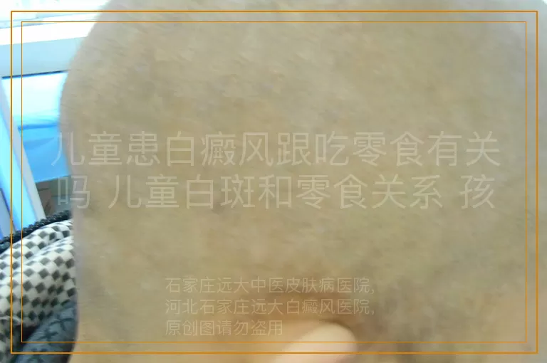 儿童患白癜风跟吃零食有关吗 儿童白斑和零食关系 孩子得白癜风是吃零食导致的吗