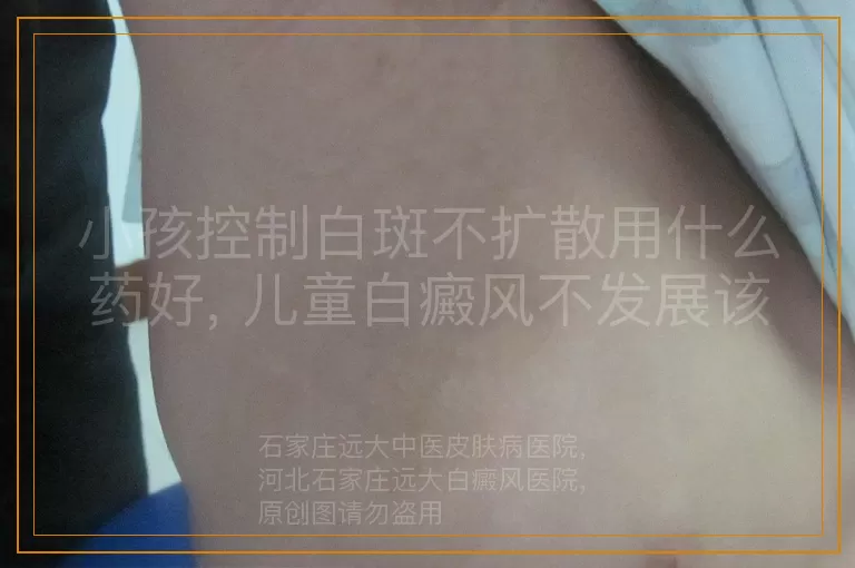 小孩控制白斑不扩散用什么药好, 儿童白癜风不发展该用什么药, 孩子白斑控制不发展用什么药