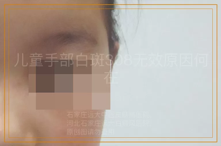 儿童手部白斑308无效原因何在