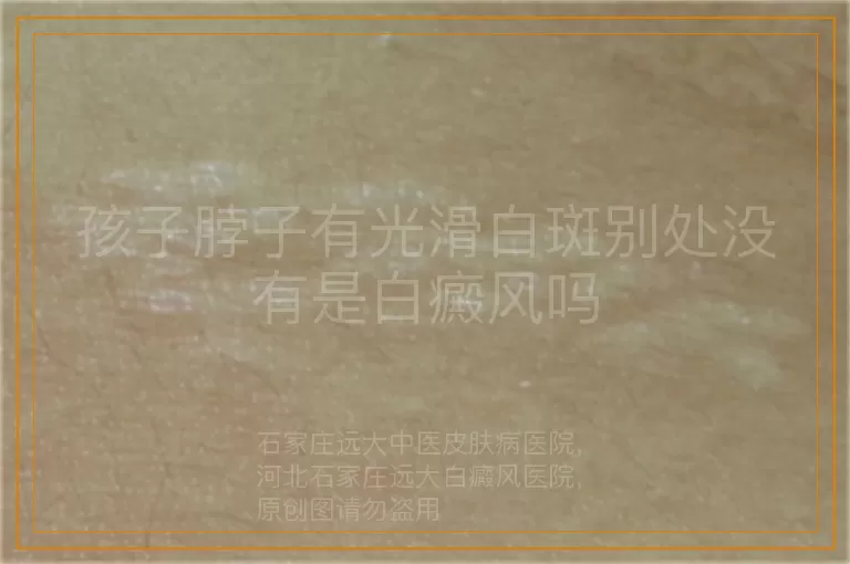 孩子脖子有光滑白斑别处没有是白癜风吗