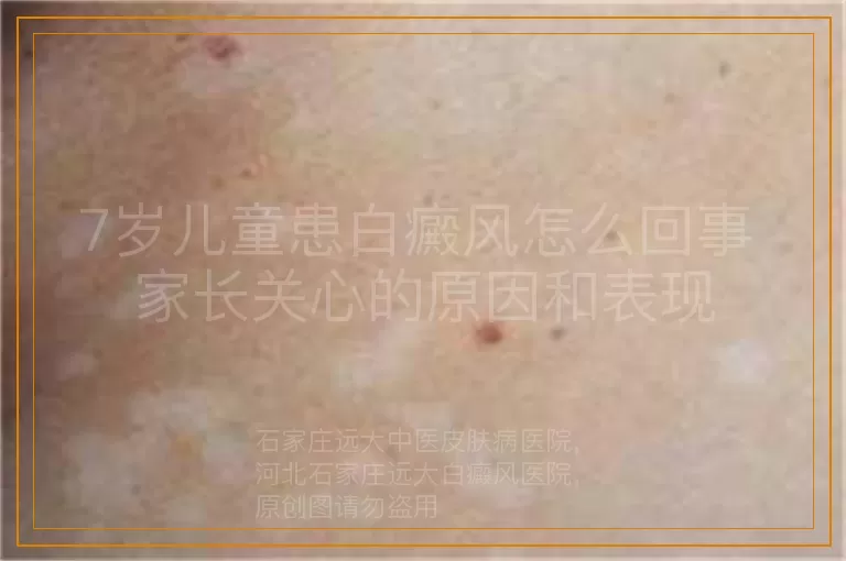 7岁儿童患白癜风怎么回事 家长关心的原因和表现