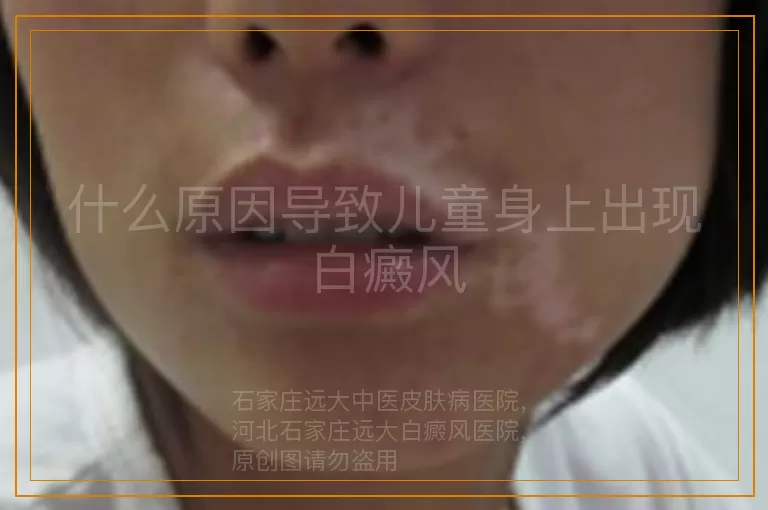 什么原因导致儿童身上出现白癜风
