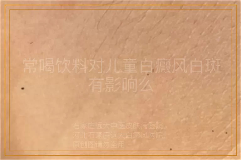 常喝饮料对儿童白癜风白斑有影响么