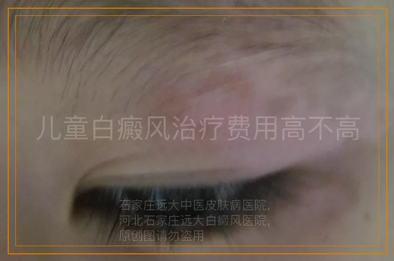 儿童白癜风治疗费用高不高