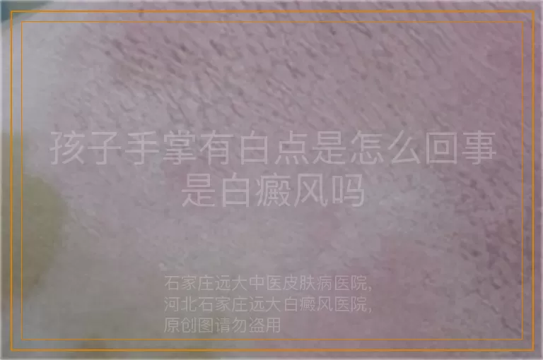 孩子手掌有白点是怎么回事是白癜风吗